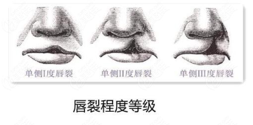 重庆可以治疗唇裂手术的医院精选