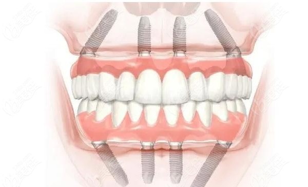 熙直美种植牙的临床应用与患者反馈