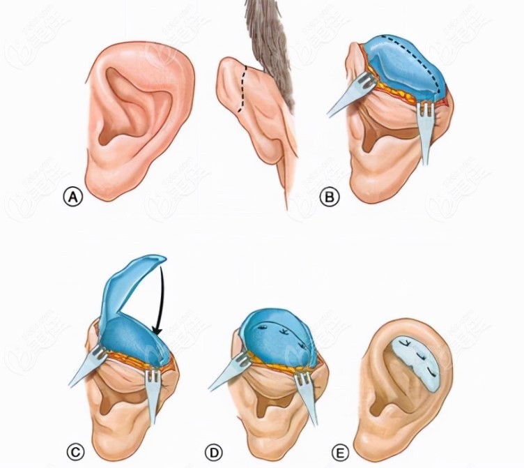 耳朵再造手术过程图
