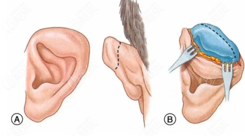 耳再造手术术式选择综述与选择建议