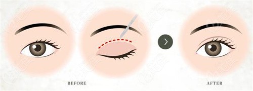 <!--<i data=20240703-sp></i>-->欣做双眼皮技术好在—个性化设计，自然和谐