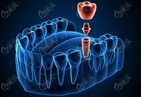 杭州雅莱齿科数字化种植牙优势