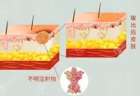 北京<!--<i data=20240703-sp></i>-->取生长因子真的能取干净