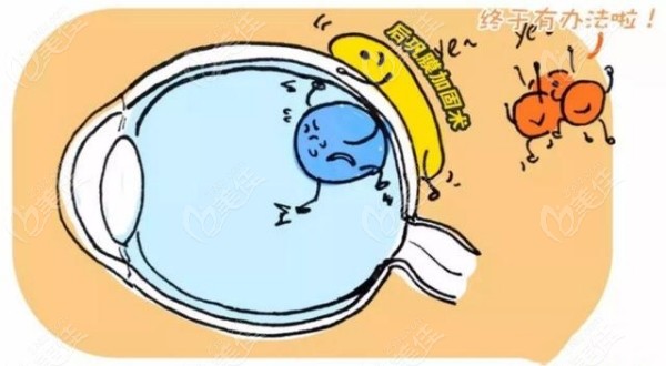 齐越医生做儿童后巩膜加固术好吗