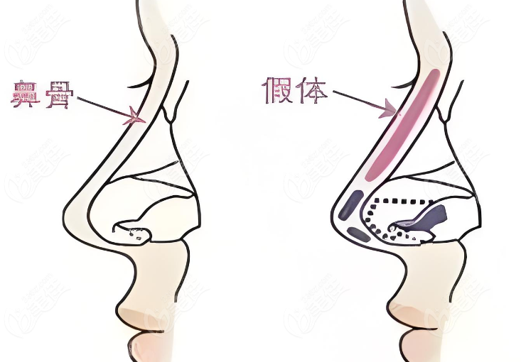 術后療效持久性：超肋鼻與肋骨鼻哪個更持久？