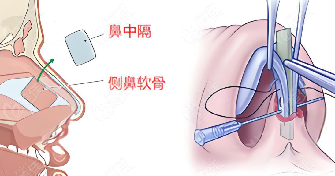 術后風險對比www.236z.com