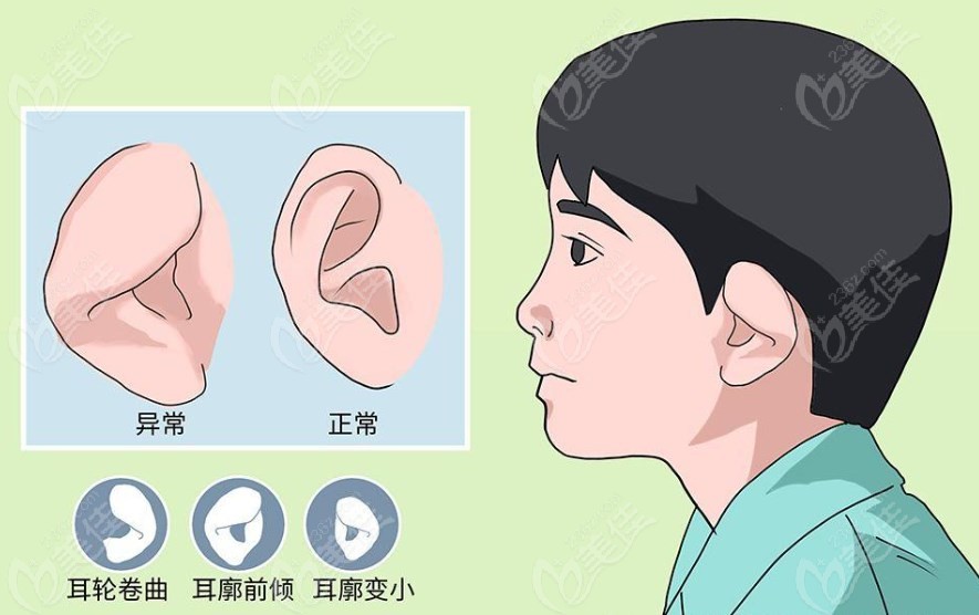 耳朵畸形种类