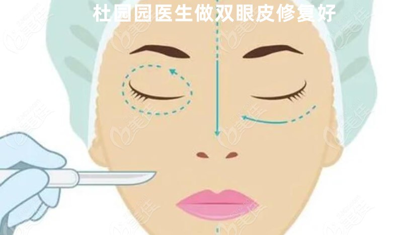 杜园园医生做双眼皮示例图