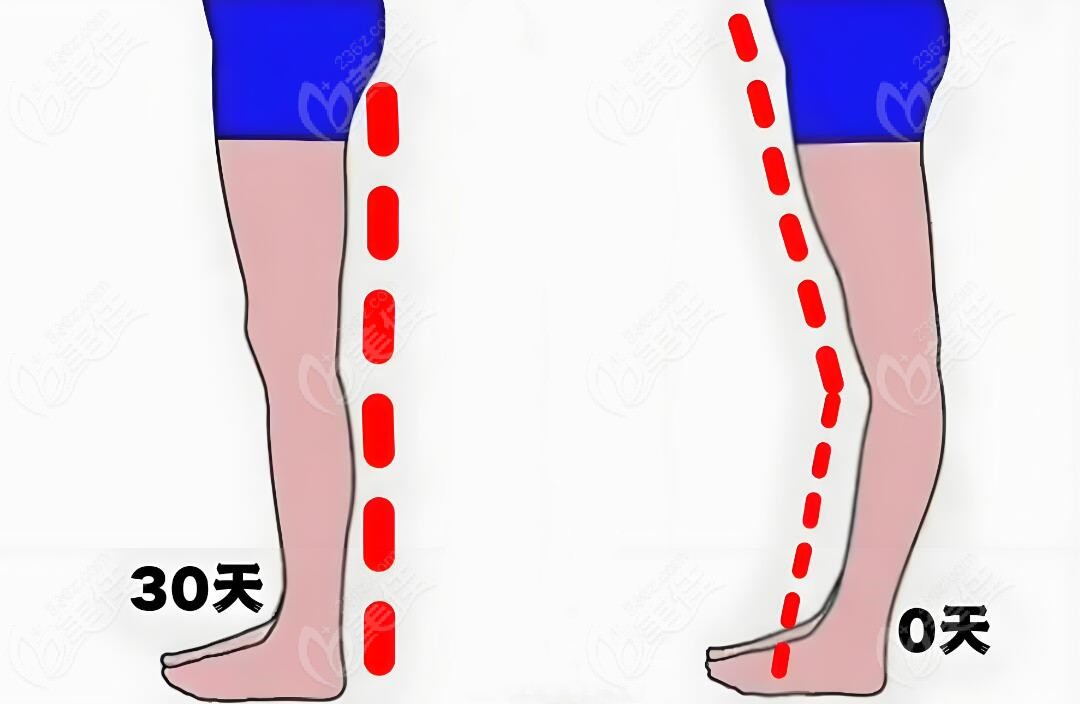 北京知音李奇軍直腿術(shù)怎么樣