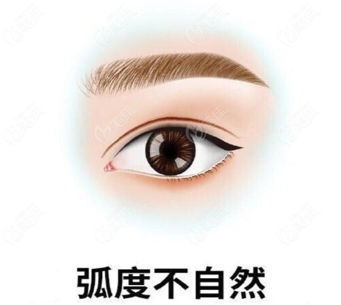 <!--<i data=20240703-sp></i>-->修复双眼皮好的优势