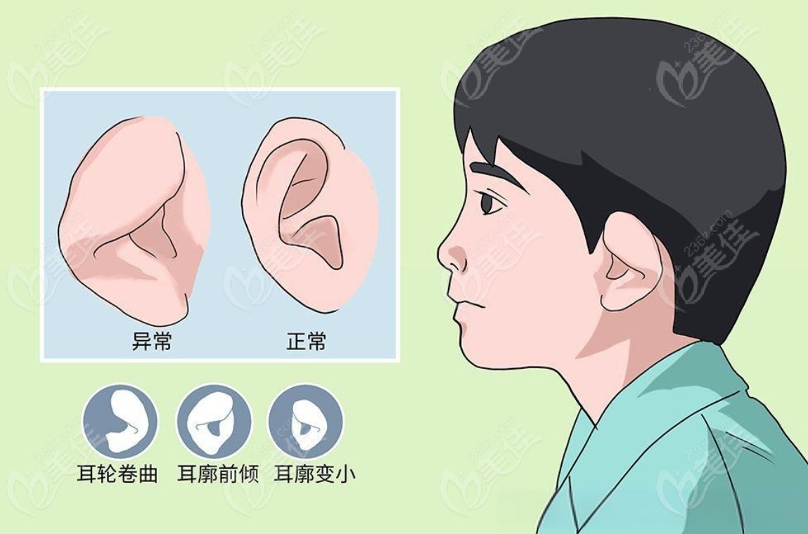 小耳畸形可能是因为环境因素造成的