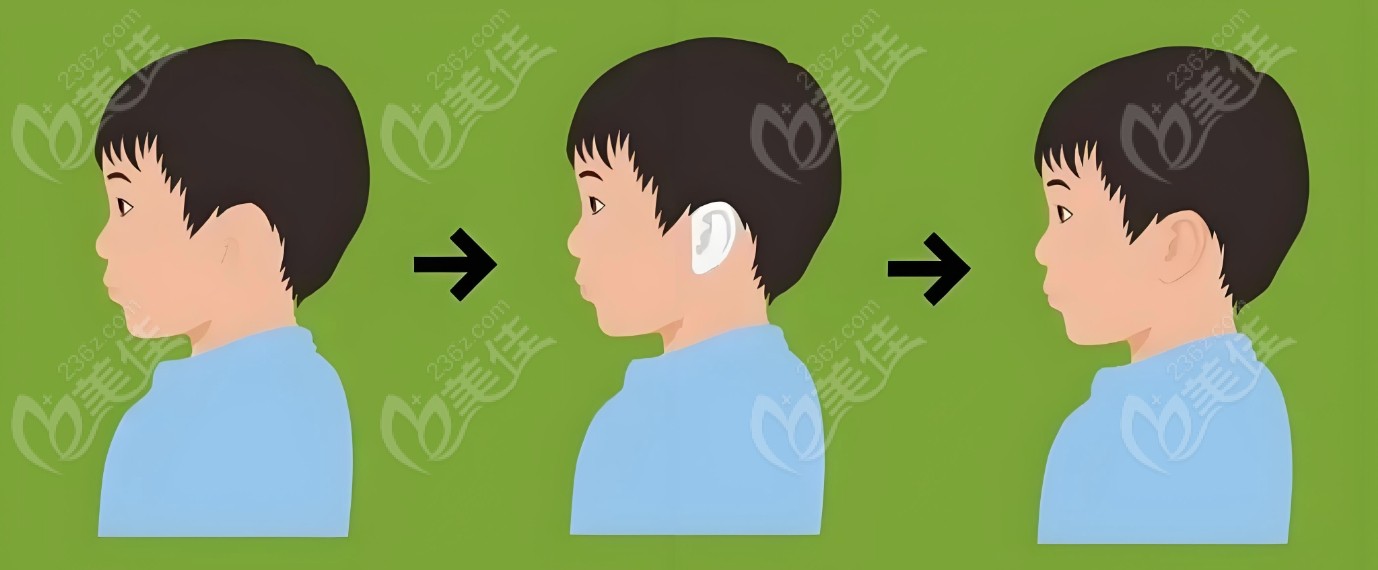 小耳畸形可能是因为未知或随机因素造成的