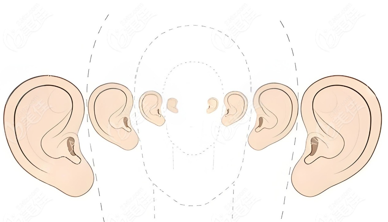 小耳畸形三度（重度）