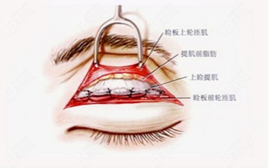 眼部修复手术示意图