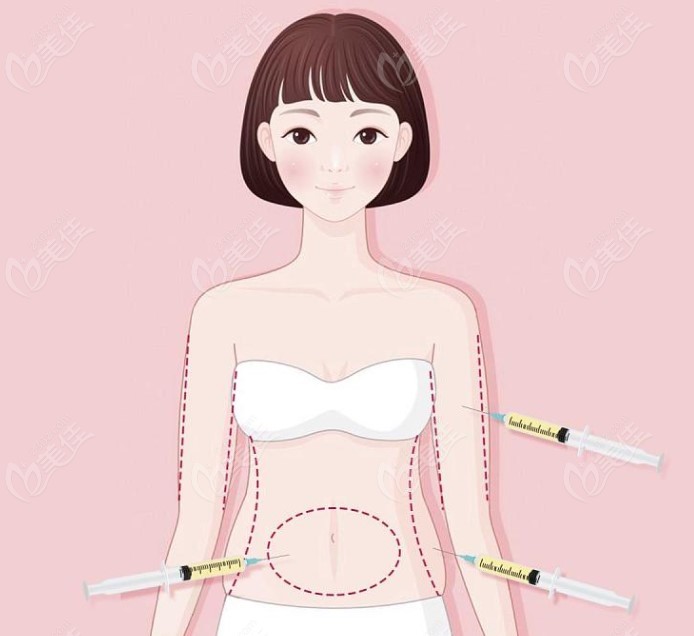 北京黃杰醫生吸脂好