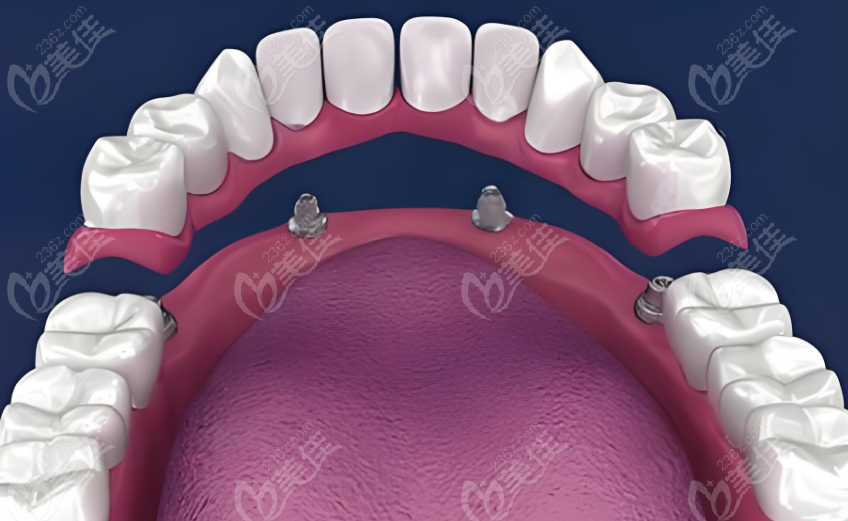 牙龈萎缩与牙周病的关系