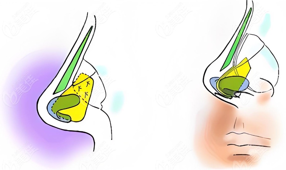 <!--<i data=20240703-sp></i>-->范荣杰做超肋鼻子,从业背景正规 <!--<i data=20240703-sp></i>-->范荣杰做超肋鼻子,从业背景正规