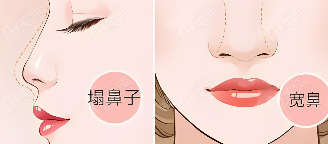 <!--<i data=20240703-sp></i>-->范荣杰做超肋鼻子吗?行业影响力情况 <!--<i data=20240703-sp></i>-->范荣杰做超肋鼻子吗?行业影响力情况