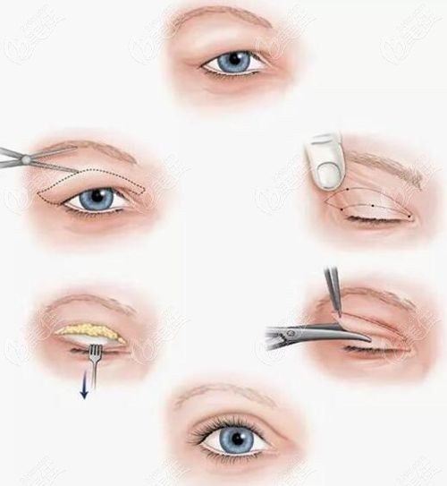 宋哲做双眼皮手术过程展示