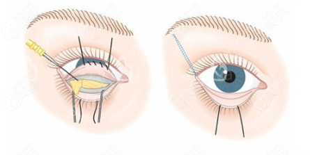 韩国大眼睛整形医院修复眼袋退缩技术真的非常到位
