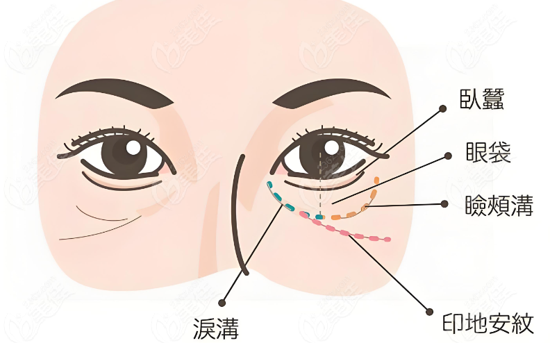 韩国大眼睛整形医院修复眼袋退缩同时还能做出卧蚕
