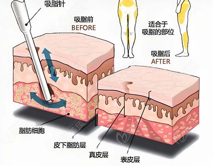 吸脂示意图