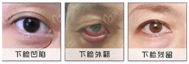 鄭州眼袋修復(fù)王楊醫(yī)生簡介www.23/6z.com