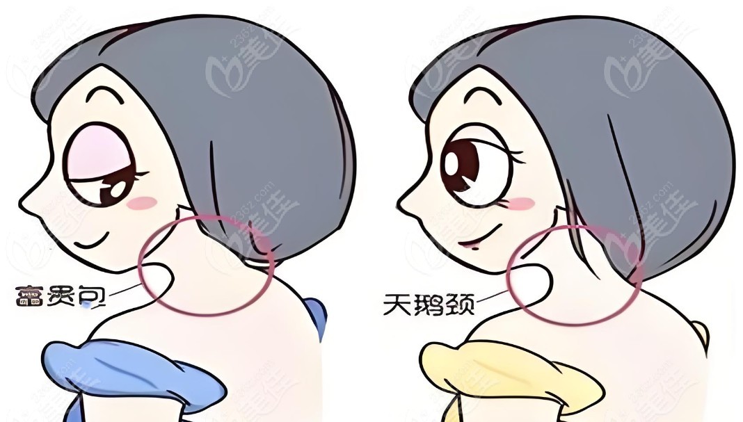 曹孟君富貴包抽脂和普通吸脂有啥區(qū)別