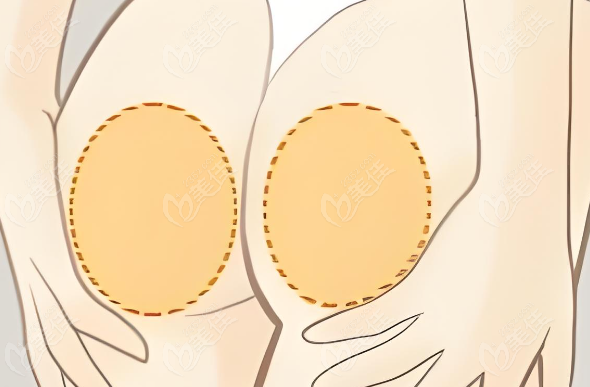 常双明5D脂肪艺术臀雕可打造丰满立体翘臀