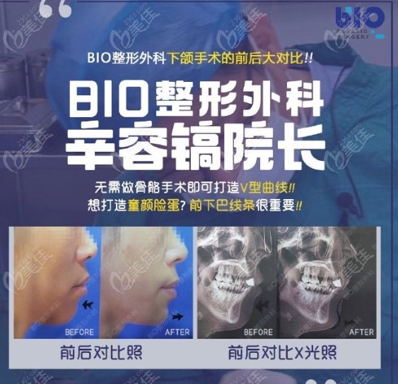 韩国BIO整形医院-辛容镐院长病例