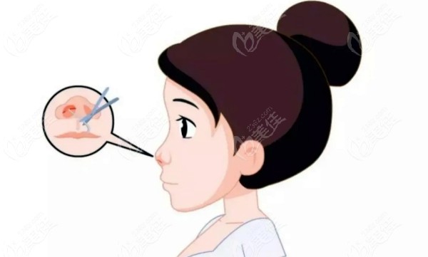 李信锋鼻整形价格