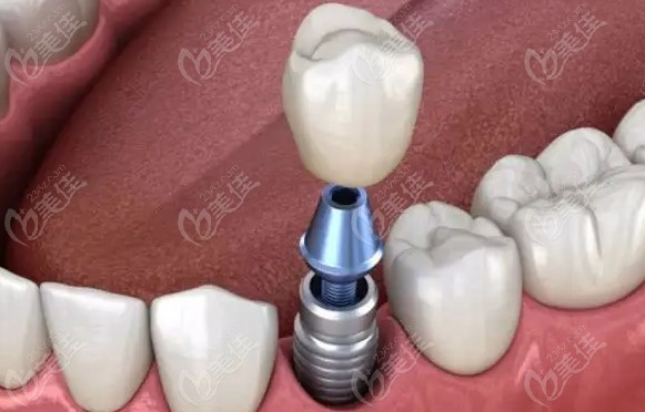牙博士口腔医院种植牙价格表m.236z.com