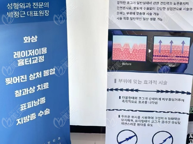 韩国Faceplus整形外科埋线提升手术优势