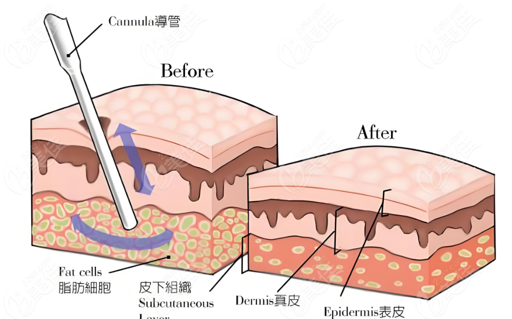 馮斌醫生吸脂技術演示