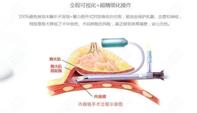 深圳军科整形做水滴假体隆胸内窥镜技术更熟练
