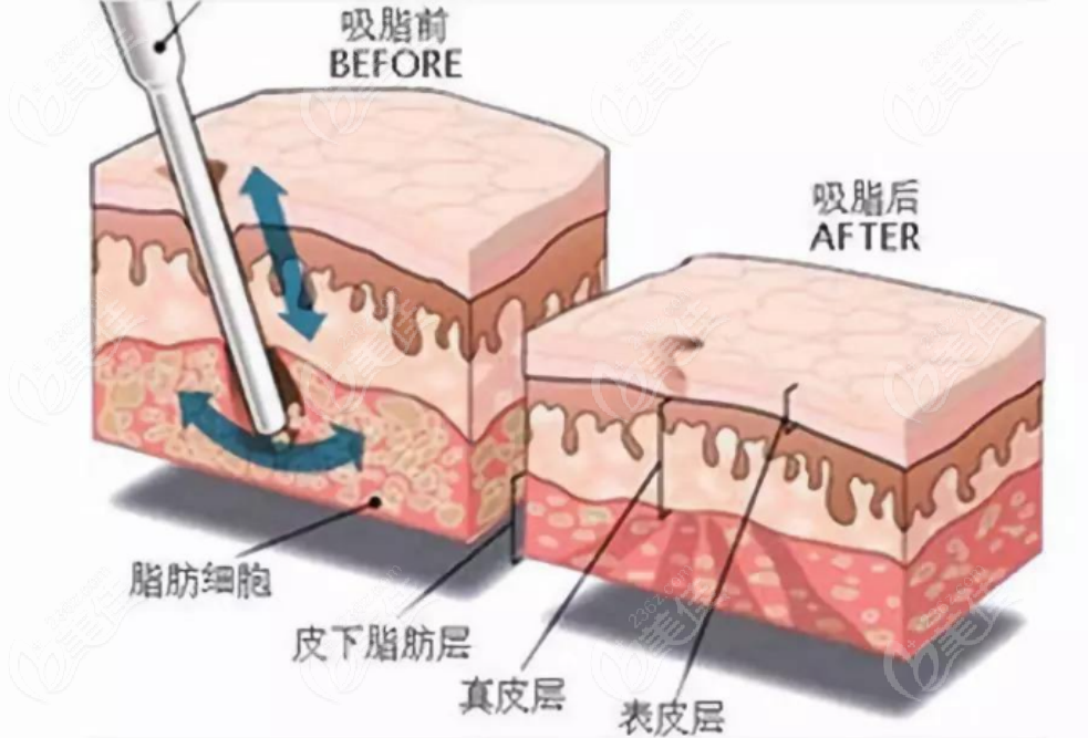 吸脂手術示意圖