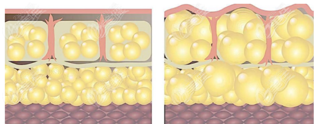 236z.com吸脂手術示意圖