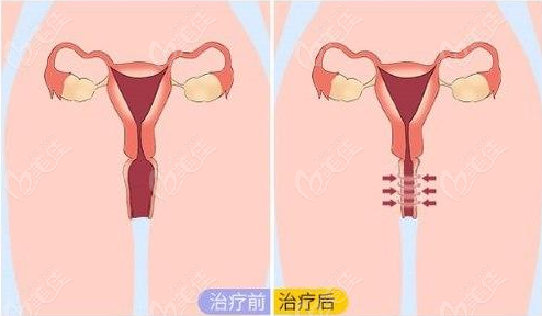 北京做3D生物束帶緊縮療效好