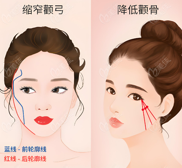 【李运峰颧骨内推预约】内推对比图,成功实例,手术量排期展示