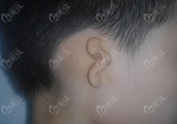 蒋海越做耳朵手术怎么样www.2/36z.com