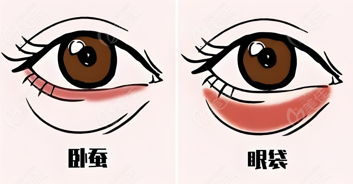 眼袋和卧蚕的区别