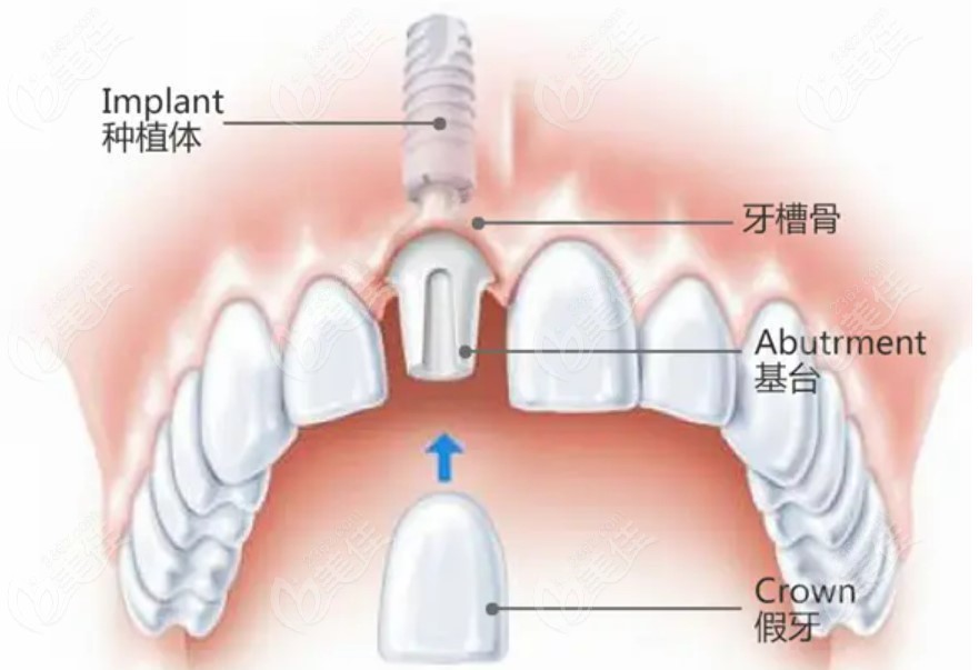 东营种植牙2024价格表m.236z.com