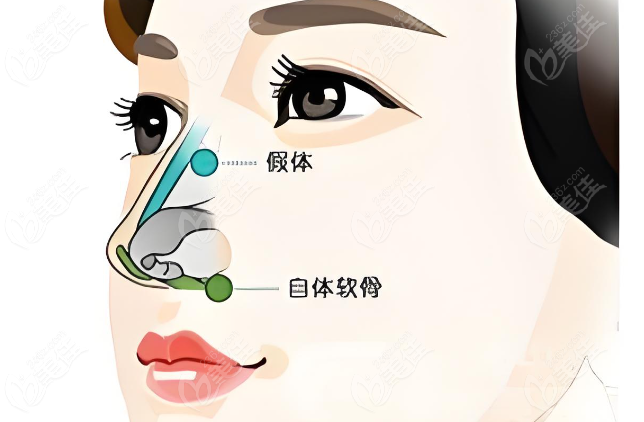 杭州李保锴医生做鼻子多少钱？