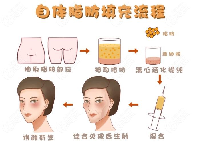 自体脂肪填充过程详解236z.com