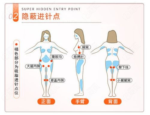 南京美貝爾快樂吸脂技術可靠