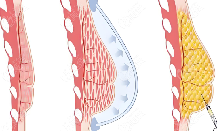 薛瑞醫(yī)生隆胸怎么樣？