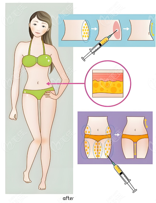 冯斌和孙波医生的吸脂手术实例