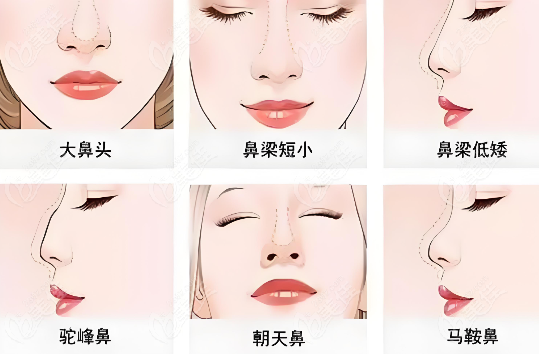上海吴应凯鼻子做得好吗
