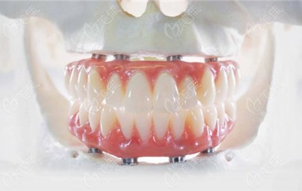 牙元素种植牙技术