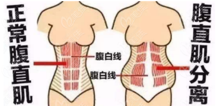 腹壁整形手术示意图